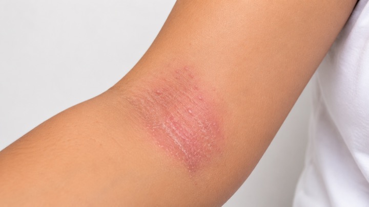 Dermatitis