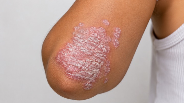 Psoriasis
